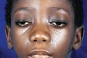 Clinical Review: Myasthenia gravis