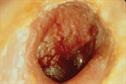 Clinical Review - Turner syndrome