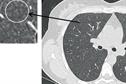 Clinical Review: Hypersensitivity pneumonitis