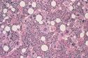 Haematology - Myelofibrosis