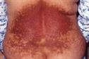 Emergency medicine - Managing burns and scalds