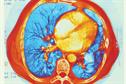 Clinical Review: Cystic fibrosis