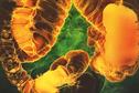 Journals Watch - Diverticulitis, statins and cancer