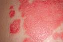 Clinical review of managing psoriasis in primary care