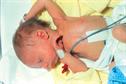 Haematology - Haemolytic disease of the newborn