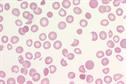 Haematology - Thrombotic thrombocytopenic purpura