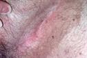 Pictorial Case Study: Groin rash