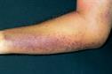 Haematology - Disseminated intravascular coagulation