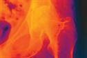 Journals Watch - Osteoporosis, diabetes and BP