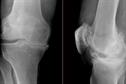 Osteoarthritis - Clinical review