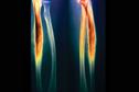 Recognising cancer in teenage patients