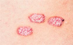 Steroid topical for psoriasis