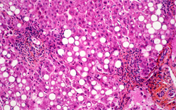 New single-tablet option for hepatitis C