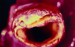 MIMS summary of JBS3 cardiovascular guideline now available