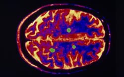New MS treatment accepted by NICE