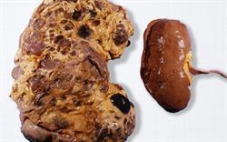 Jinarc: first treatment for polycystic kidney disease