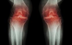 Bisphosphonates: rare risk of ear osteonecrosis