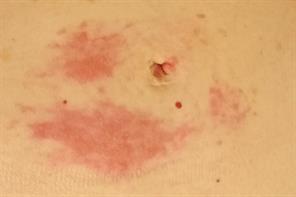 Pictorial Case Study - Sister Mary Joseph nodules