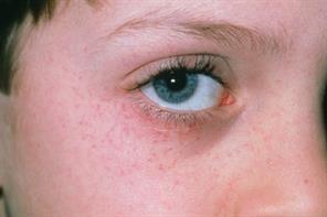 Pictorial case study: a petechial rash