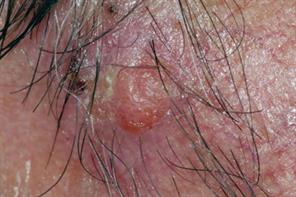 Clinical images: Malignancy