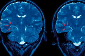 Emergency medicine - Managing seizures in epilepsy