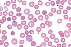 Haematology - Autoimmune haemolytic anaemia