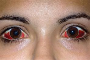 Illustrated: Conditions of the eyes