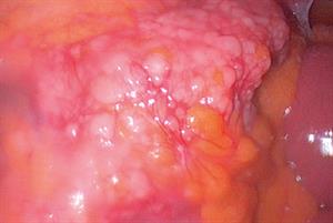 Red flag symptoms: Amenorrhoea