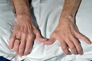 Clinical Review: Motor neurone disease