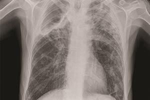 Evidence base: Pulmonary tuberculosis
