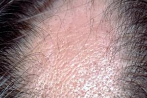 alopecia universalis regrowth signs