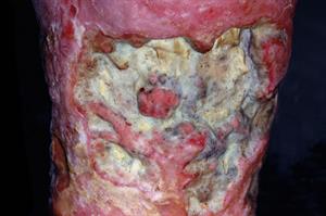 Differential diagnoses: Lower limb ulceration