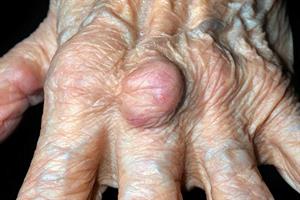 Case study: Diagnosis and management of Felty's syndrome