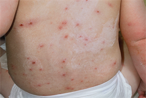 Chickenpox (varicella zoster) - Clinical Review