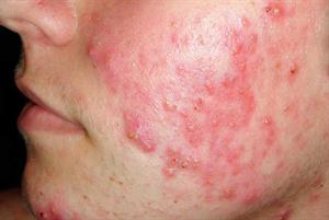 Clinical Review: Acne