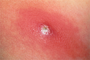 Case study: Recurrent skin infections