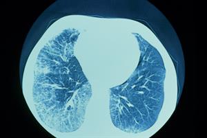 Lung disease in patients with rheumatoid arthritis