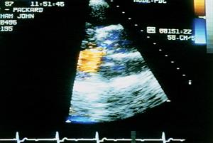 Aortic valve disease: clinical review