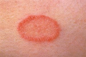 Pictorial case study - A well-defined pink lesion