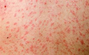 Measles: Clinical review