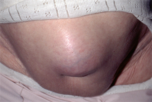Differential diagnoses: Abdominal swellings