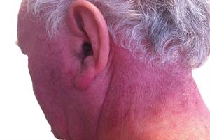 Management of common photodermatoses