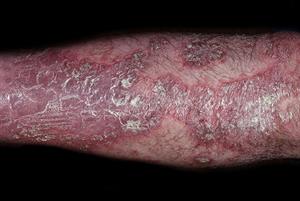 Psoriasis: differential diagnosis
