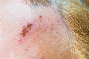 Shingles jab programme extended to 300,000 more patients