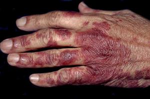 Differential diagnoses: Conditions of the hands