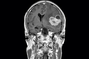 Clinical review of brain tumours