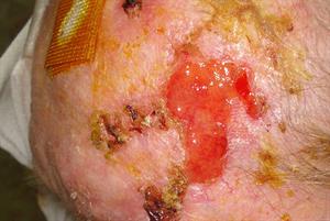 Case study: Managing erosive pustular dermatosis of the scalp