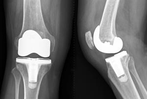 Total knee replacement