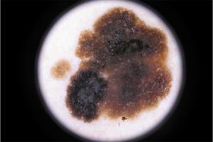 Using dermoscopy to diagnose skin lesions