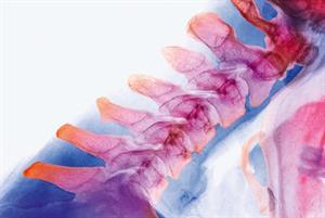 Management of clinical whiplash and neck pain